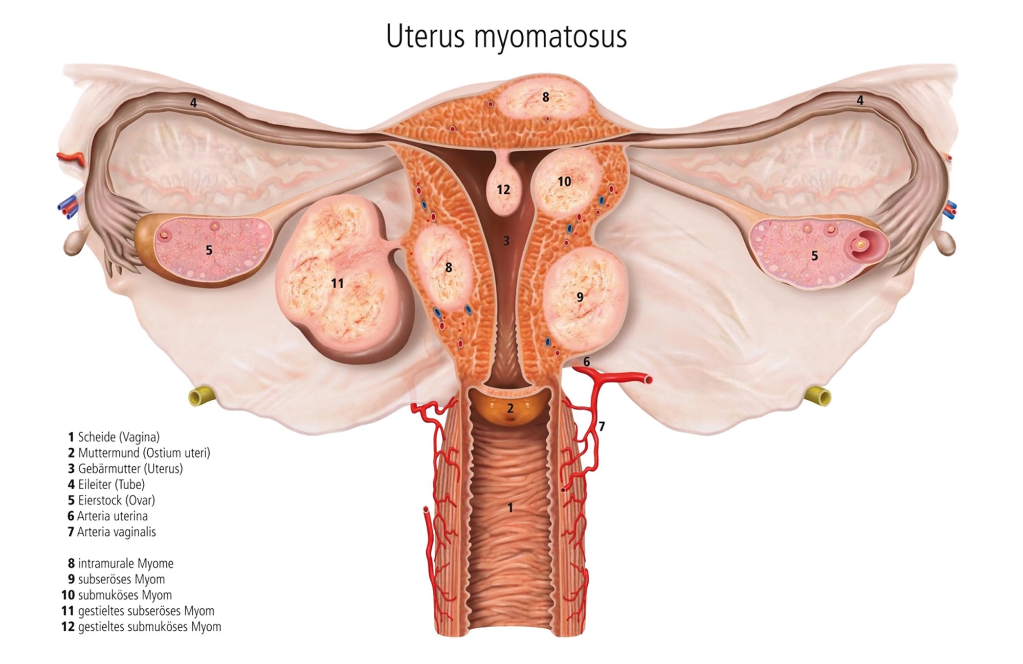 Uterus myomatosus