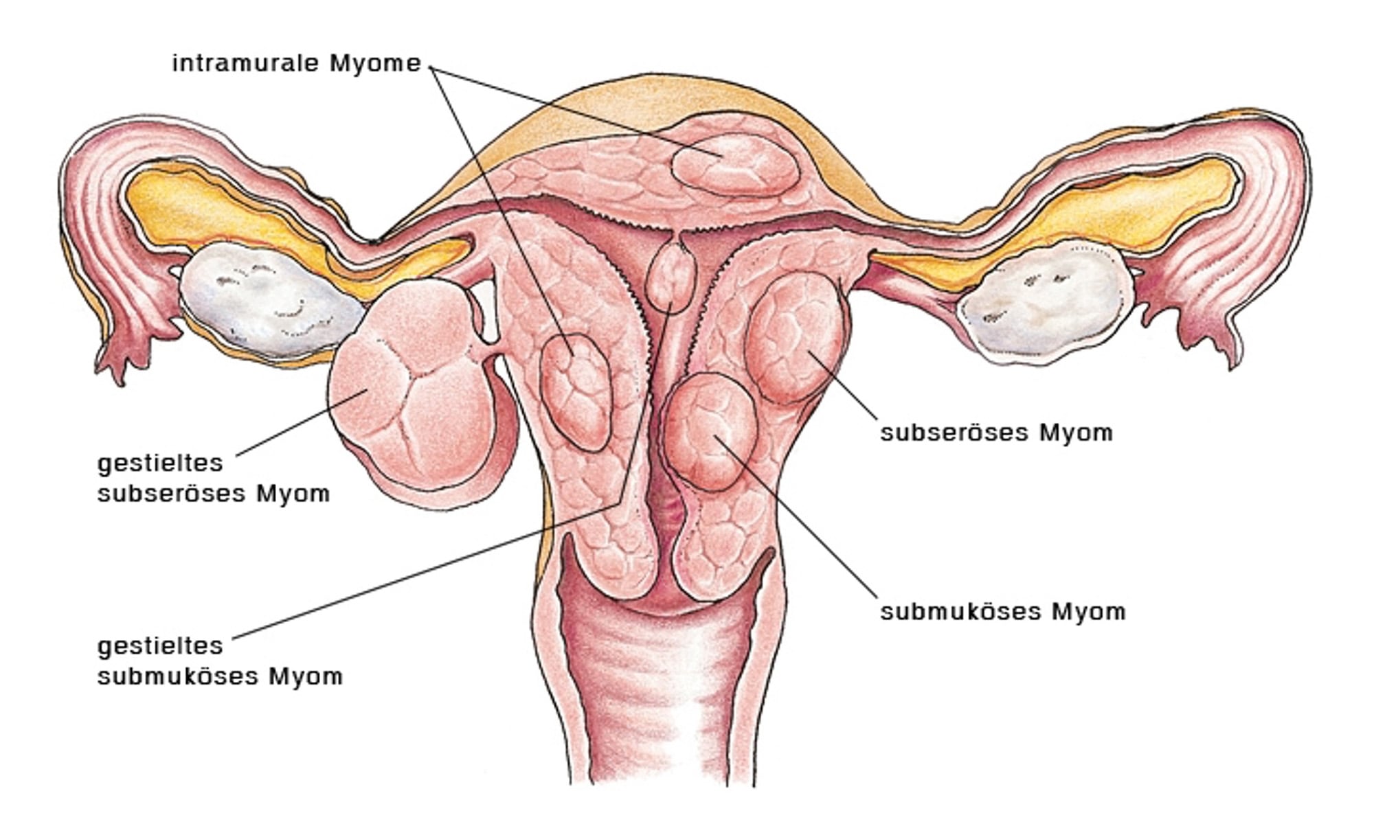 Uterus myomatosus