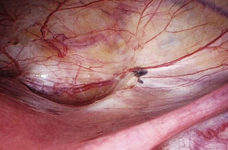 Endometriose