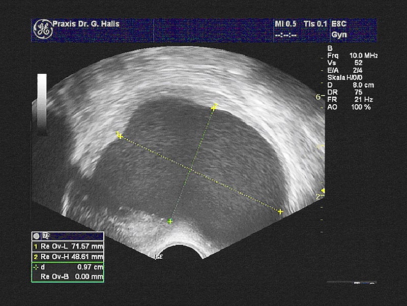 An ultrasound can be used to diagnose what are known as chocolate cysts (endometriomas).