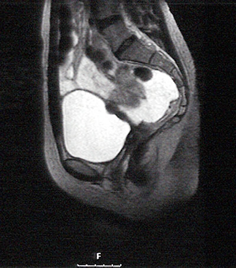 An MRI may be advisable in the advanced stages to confirm problems such as involvement of the bladder or bowel.