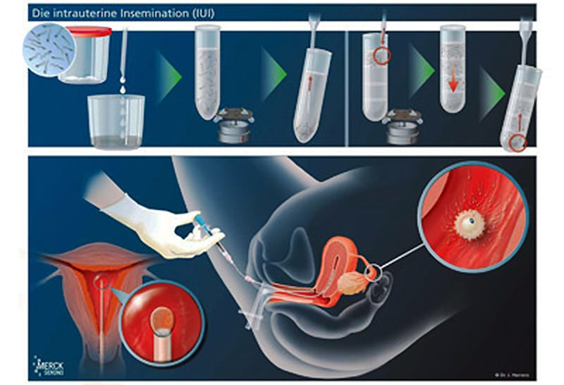Diagram: The insemination process. Above: preparing the sperm; below: insemination