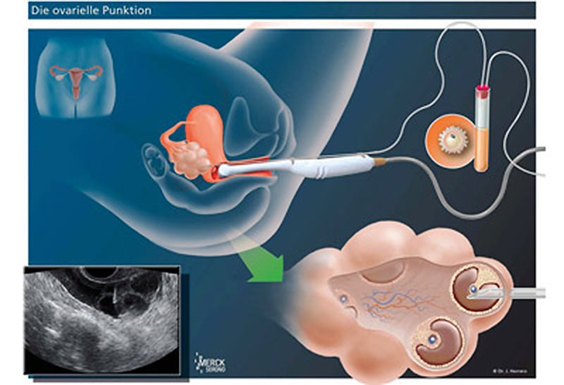 Diagram: transvaginal aspiration