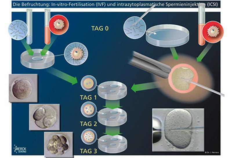 IVF/ICSI'ye gereken işçiliğin şematik anlatımı.