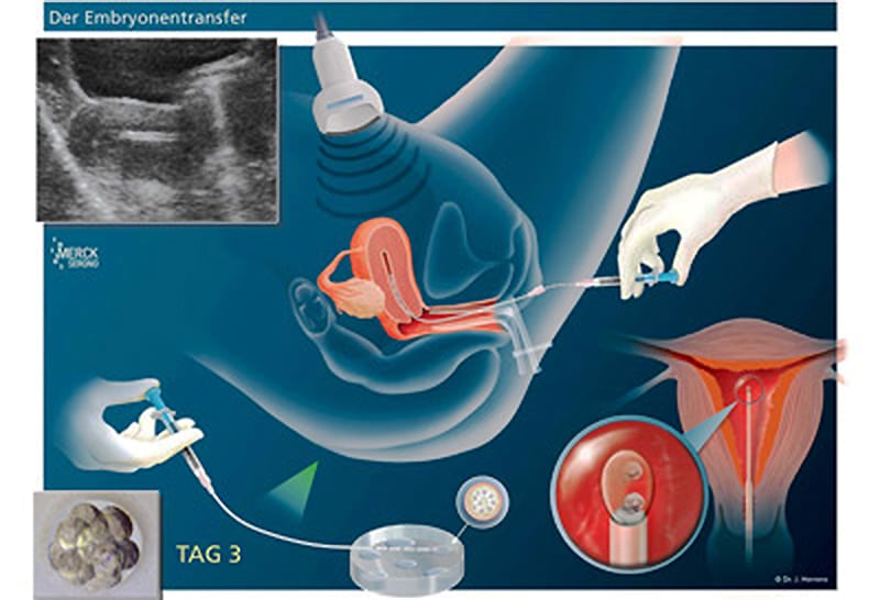 Embriyo transferinin şematik gösterimi