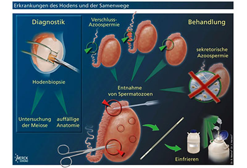 Diagram: Testicular Spermextraction (TESE)